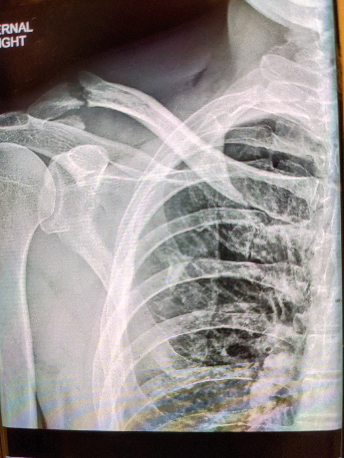 Broken Collarbone from a Car Accident: Symptoms, Treatment, and Recovery