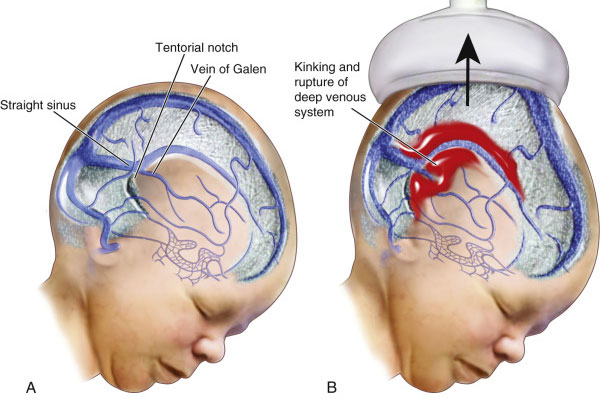 Brain Hemorrhage After Car Accident