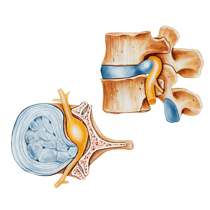 Herniated Disc in Neck Car Accident Settlement: What You Need to Know