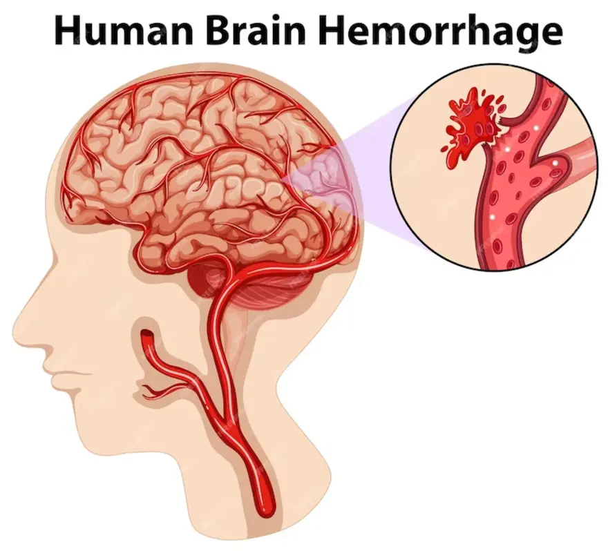 Brain Hemorrhage After Car Accident