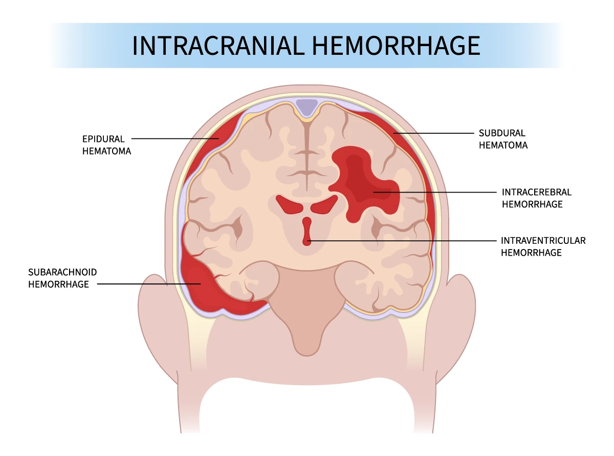 Bleeding on the Brain After a Car Accident